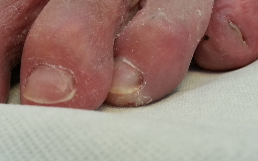 Plantarisation – a Curable Cause of Diabetic Toe Ulcers